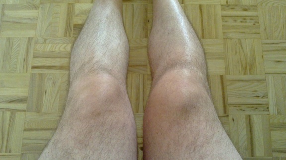 Twisted knee update: 2 months later
