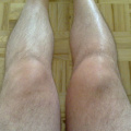Twisted knee update: 2 months later