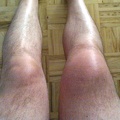 Twisted knee